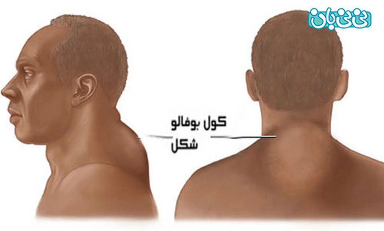 علائم سندروم کوشینگ، قابل توجه آقایان