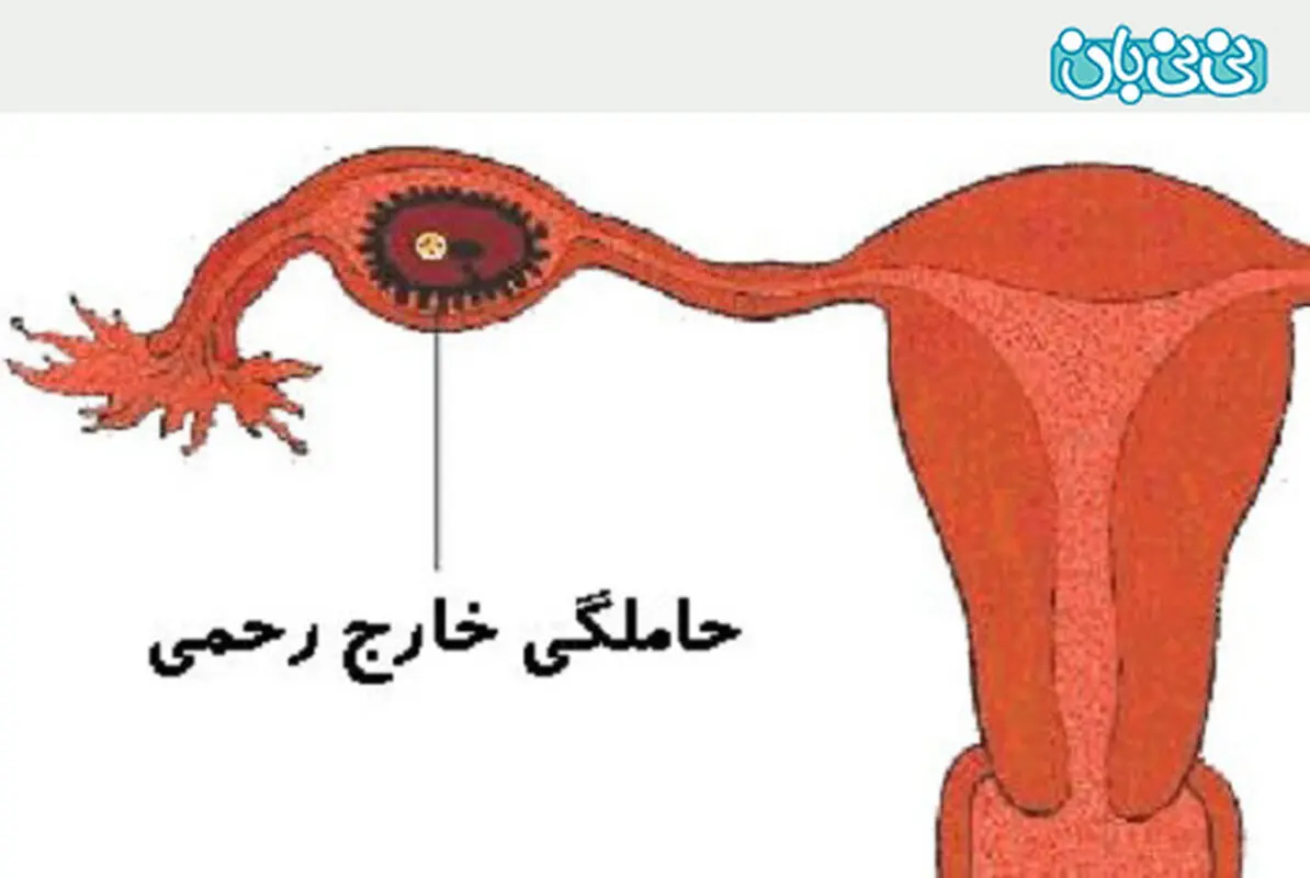 سقط خارج از رحم، خطرناکه؟
