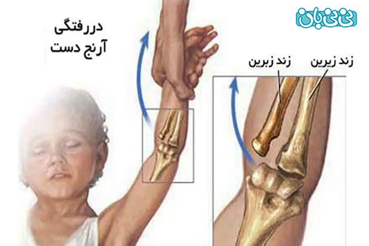 علائم در رفتگی آرنج کودک