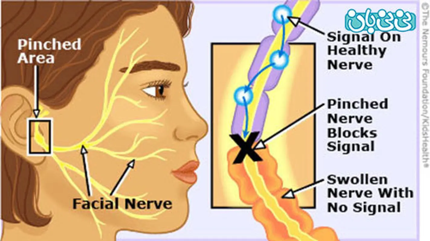 فلج بل در کودکان، علائم و نشانه‌ها