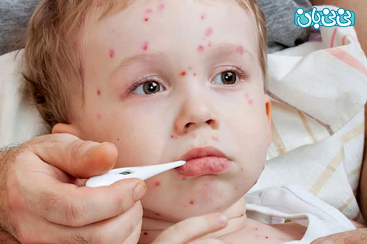 بیماری کاوازاکی در کودکان، درباره‌اش چه می‌دانید؟