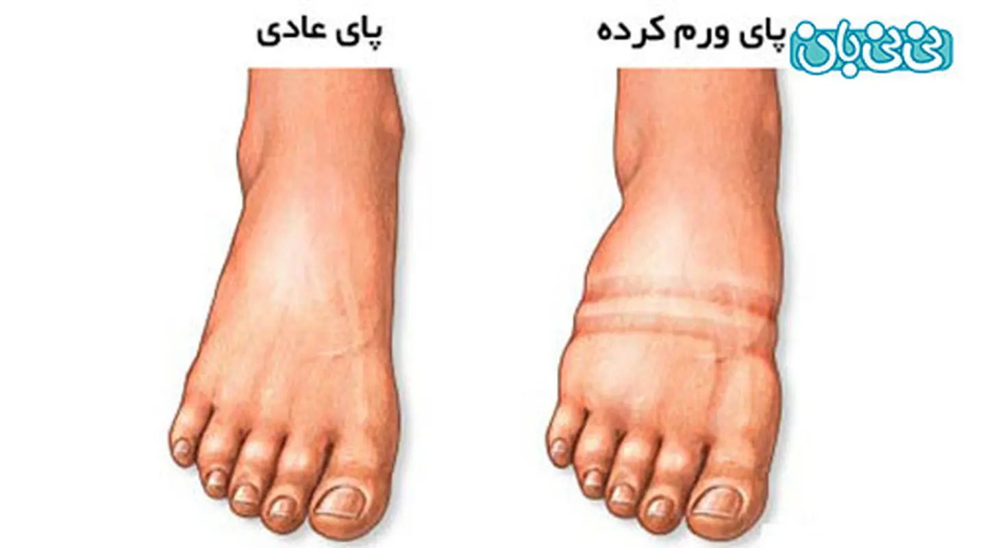 ورم پا در دوران بارداری، علت خاصی دارد؟