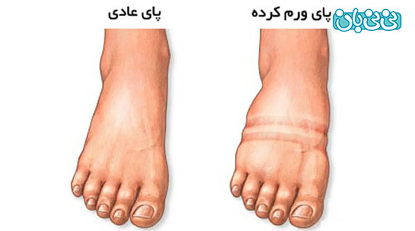 ورم پا در دوران بارداری، علت خاصی دارد؟