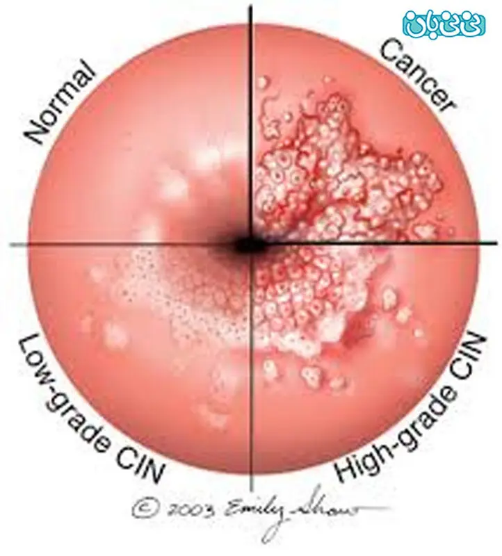 راه اندازی اولین تکنولوژی دارای تائیدیه FDA در ایران، جهت تشخیص HPV