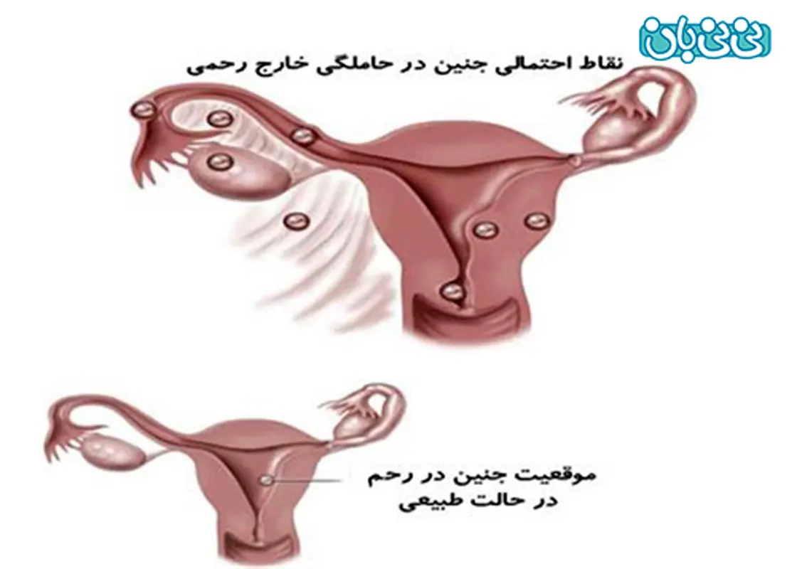 درد پهلو در بارداری، درمان دارد؟