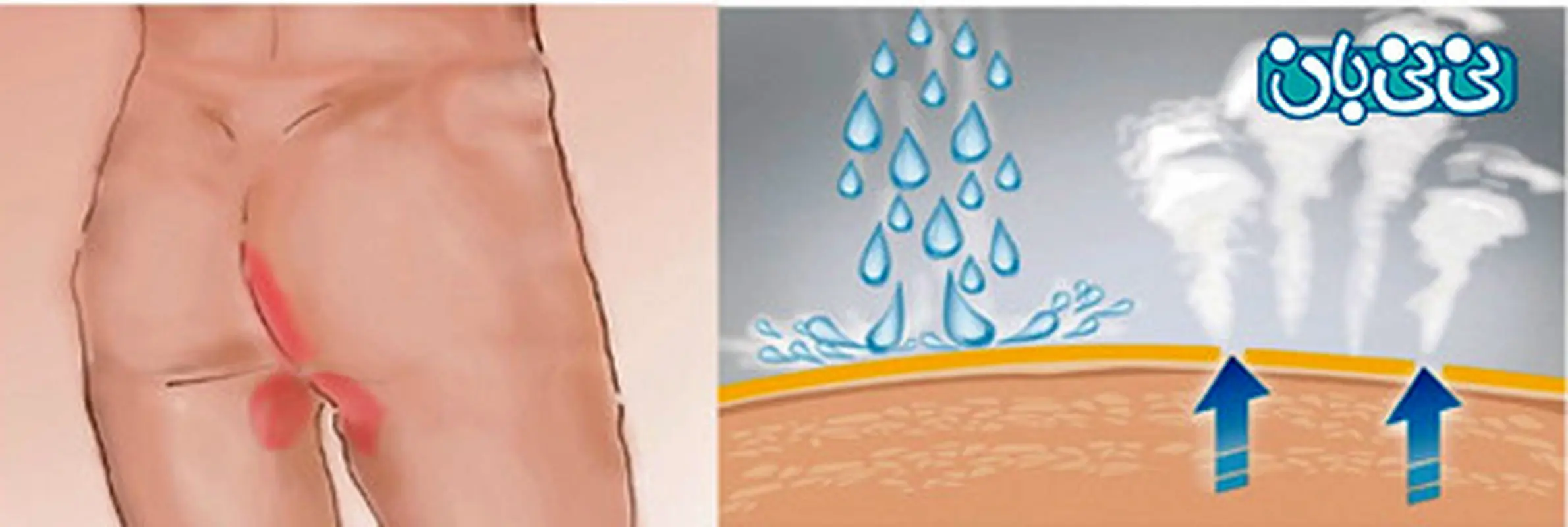 عرق سوز شدن زنان، بهترین درمان