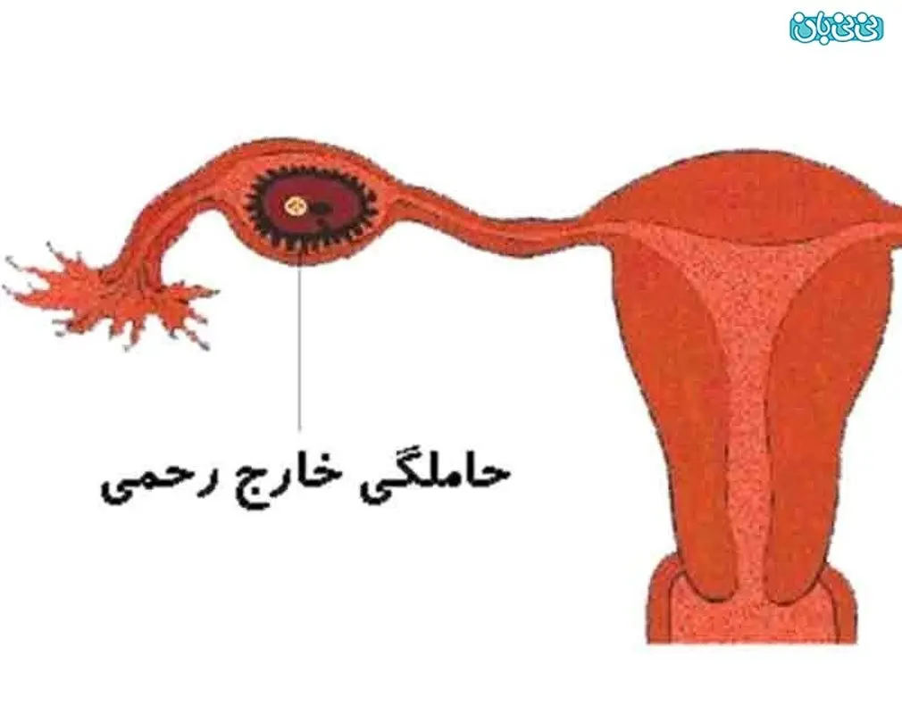حاملگی خارج از رحم، با بی بی چک منفی