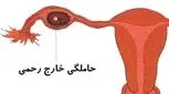 حاملگی خارج از رحم، با بی بی چک منفی