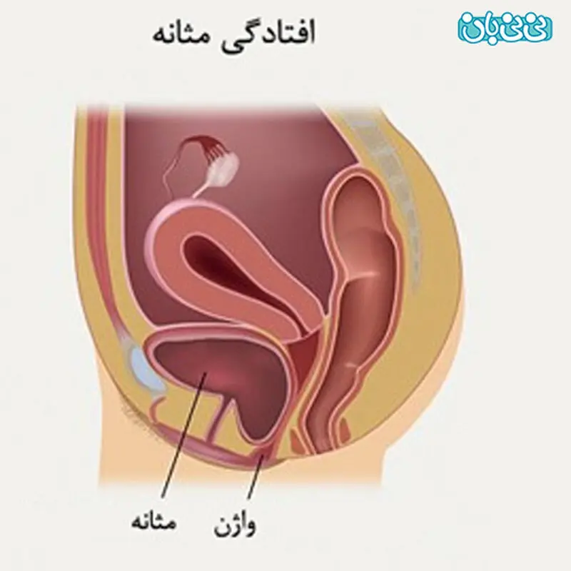 افتادگی مثانه در خانم ها، علائم و روش‌های درمان