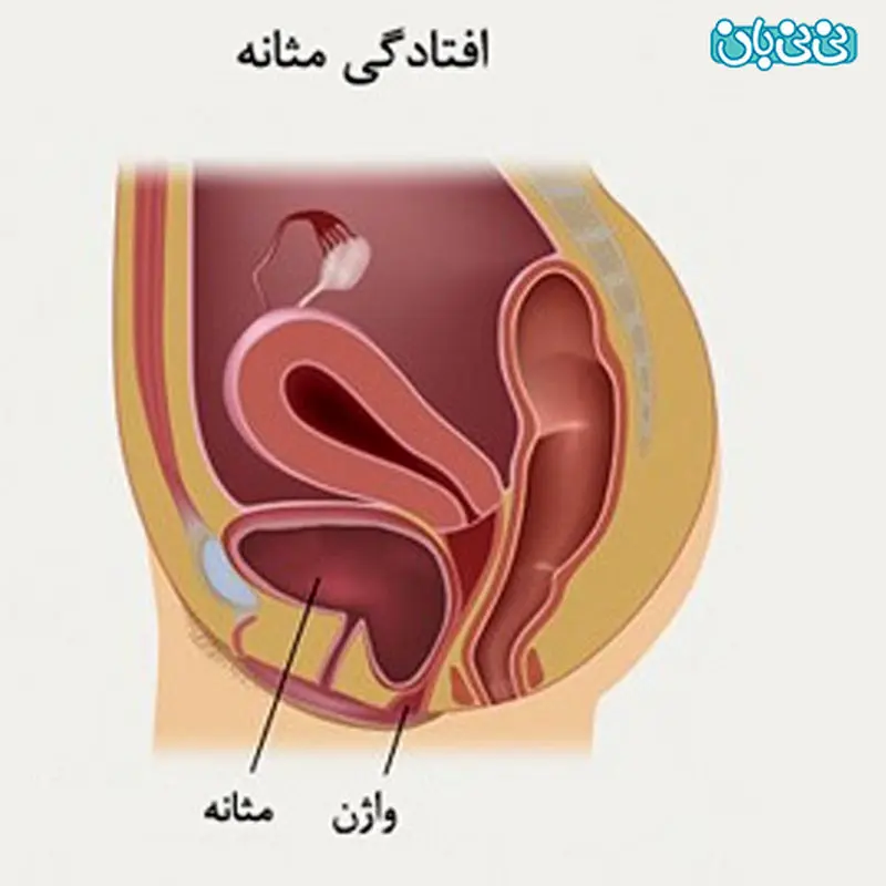 افتادگی مثانه در خانم ها، علائم و روش‌های درمان