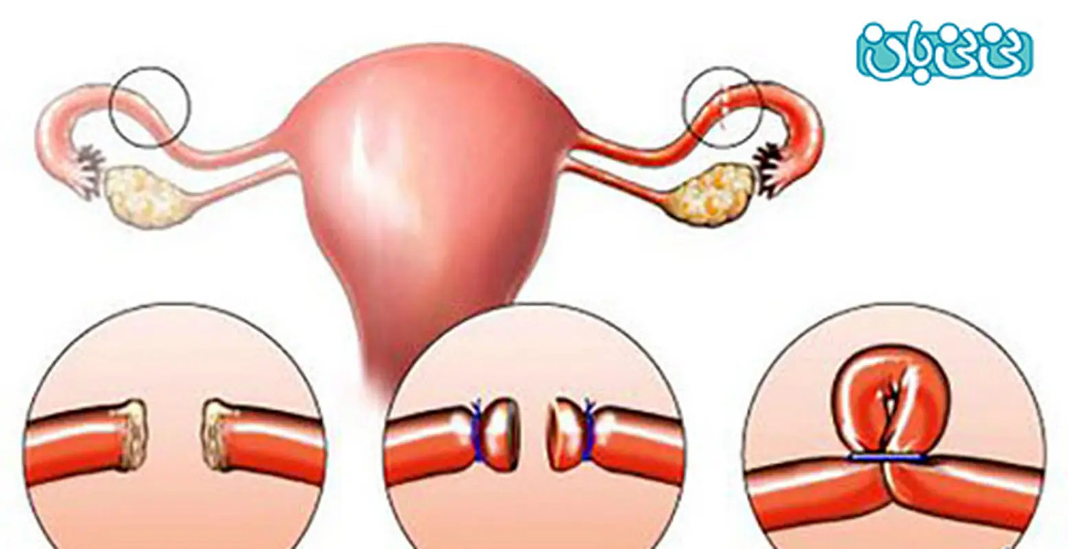 عوارض بستن لوله رحم در زنان