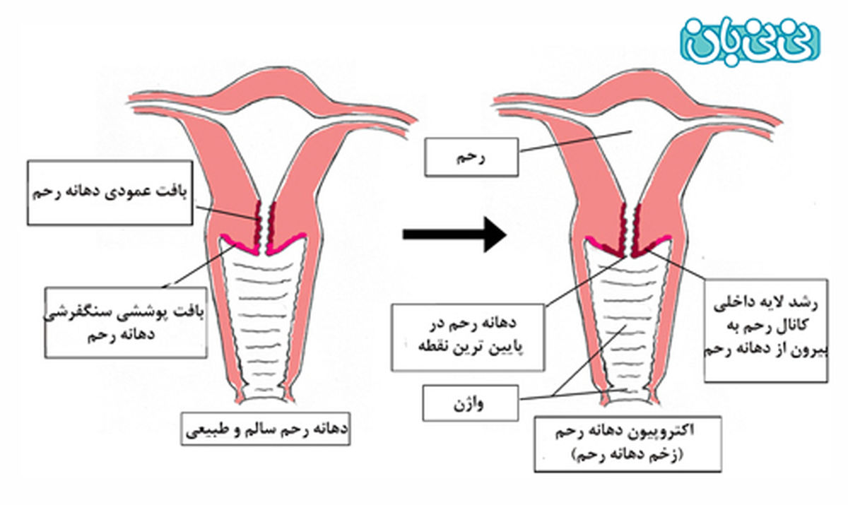 فریز کردن زخم دهانه رحم چگونه است؟