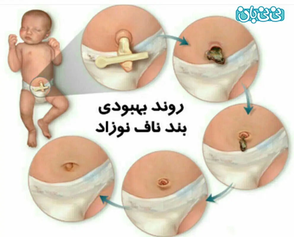 خونریزی ناف نوزاد بعد از افتادن، علت