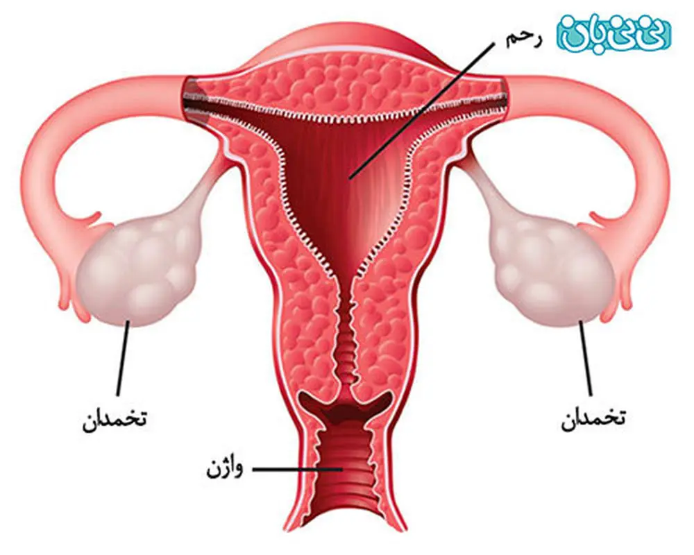 بیماری کیست تخمدان، شاید شما هم مبتلا باشید!