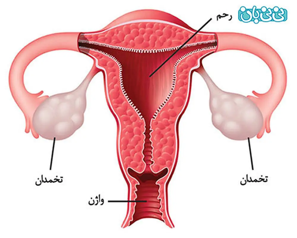 بیماری کیست تخمدان، شاید شما هم مبتلا باشید!