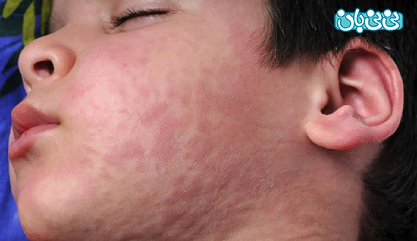 علت کهیر کودکان، چگونه درمان کنیم؟