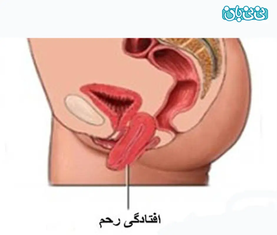 افتادگی رحم، عوارض جراحی