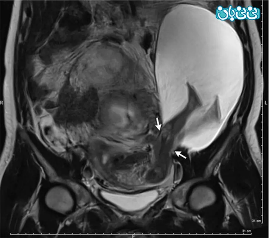 پارگی کیسه آمنیوتیک، بیرون زدگی پای جنین