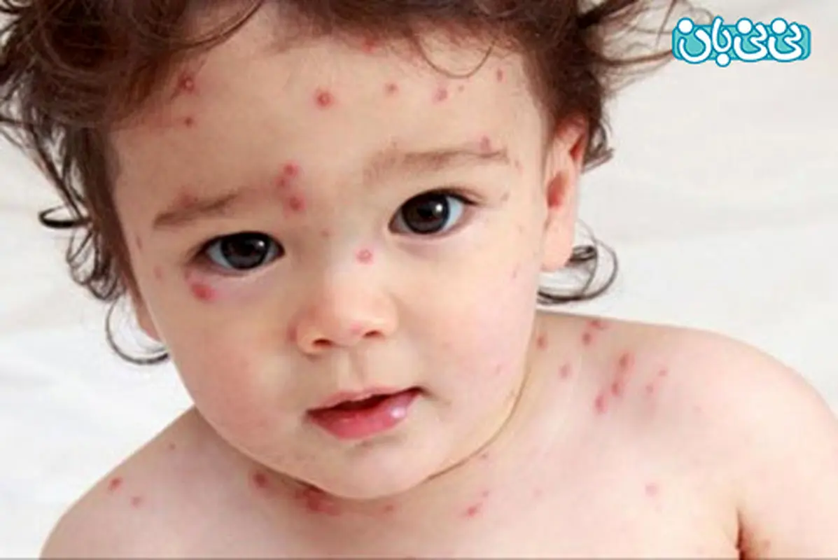 علائم بیماری مخملک در کودکان، درمانش چیست؟