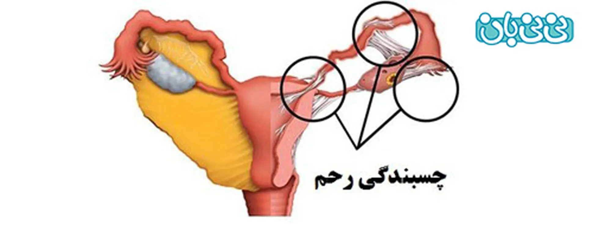 آیا سزارین باعث چسبندگی رحم میشود؟