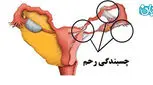 آیا سزارین باعث چسبندگی رحم میشود؟