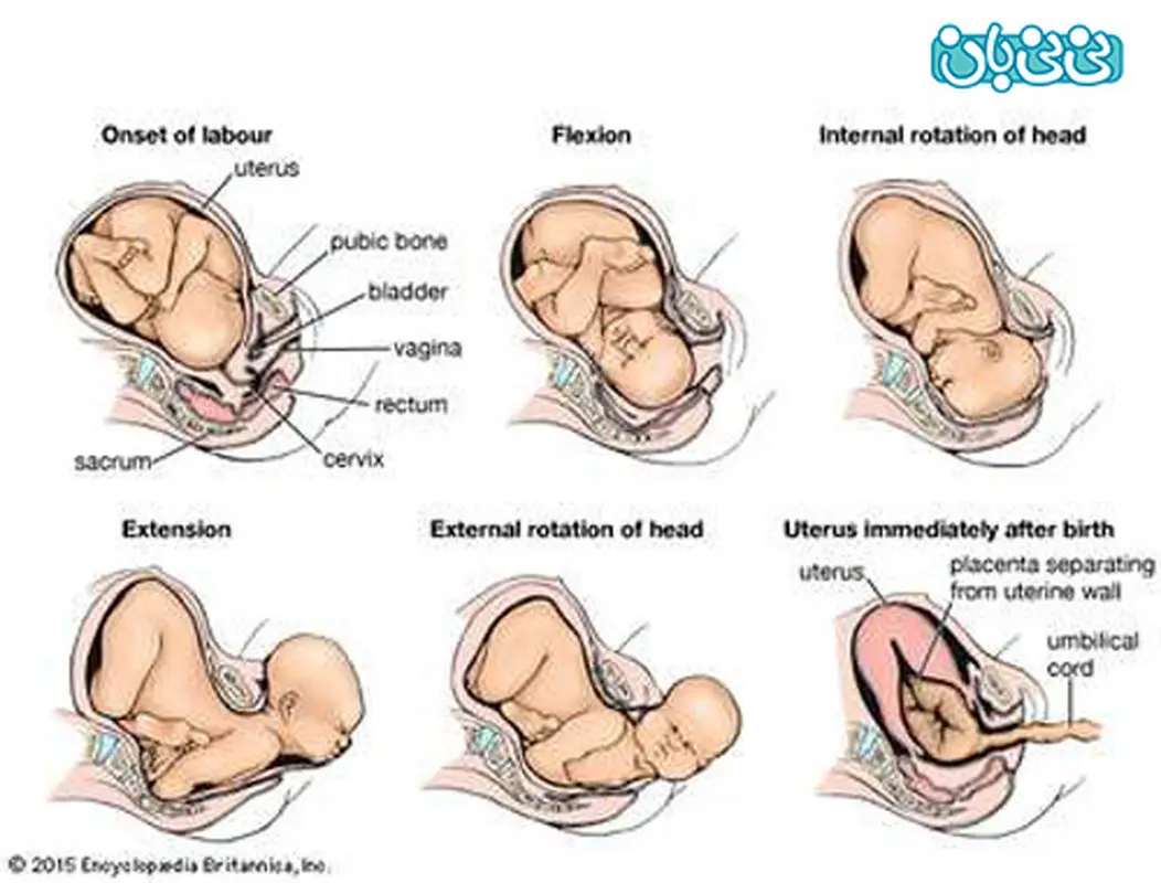 شرایط زایمان سزارین چیست؟