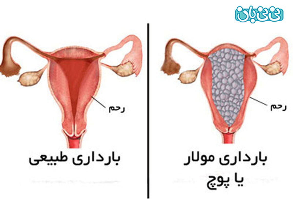 بیماری مول یا بچه خوره، آنچه باید بدانید