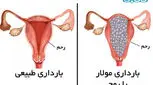 بیماری مول یا بچه خوره، آنچه باید بدانید