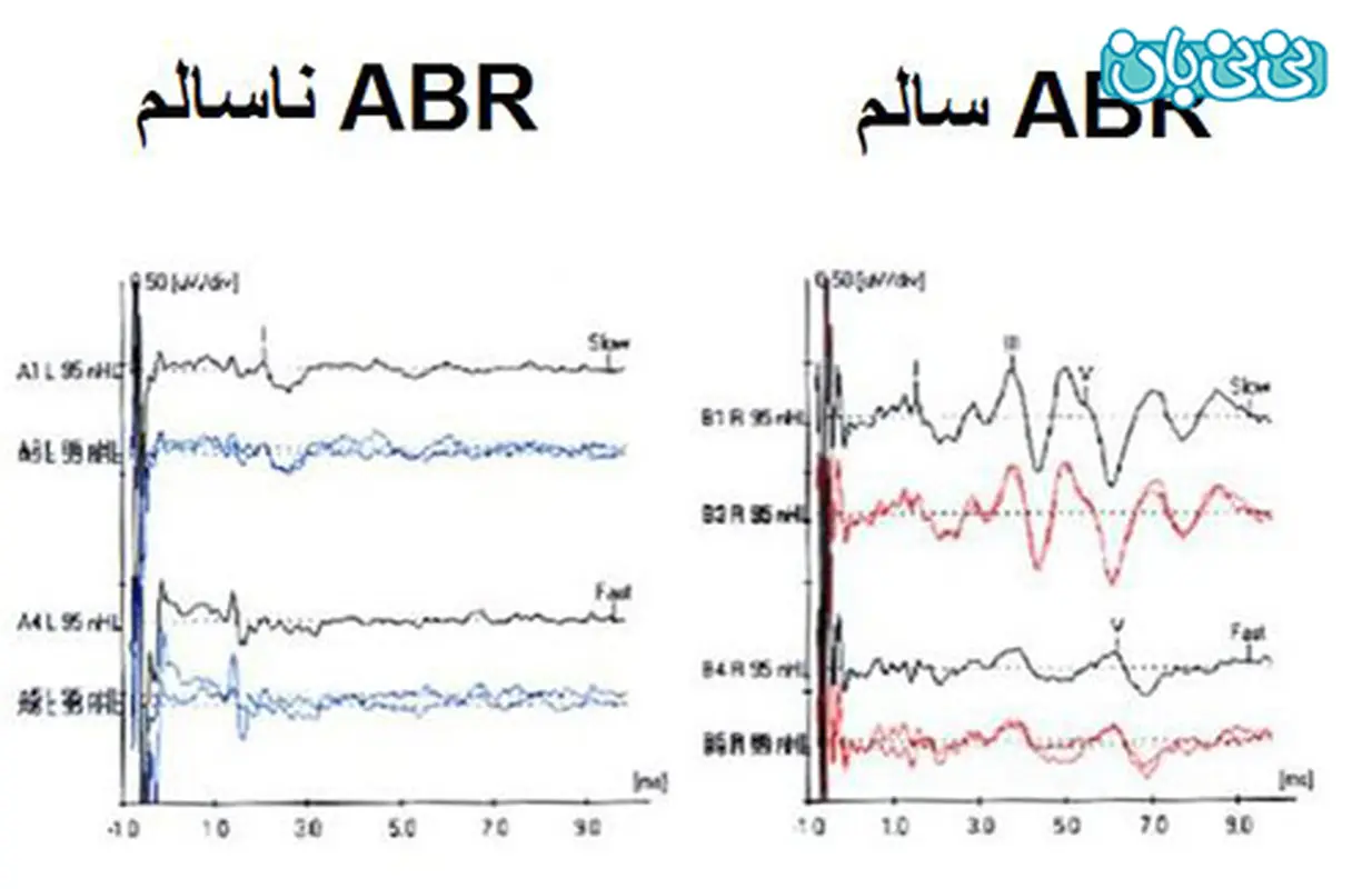 تست شنوایی نوزاد، مهمترین نکات