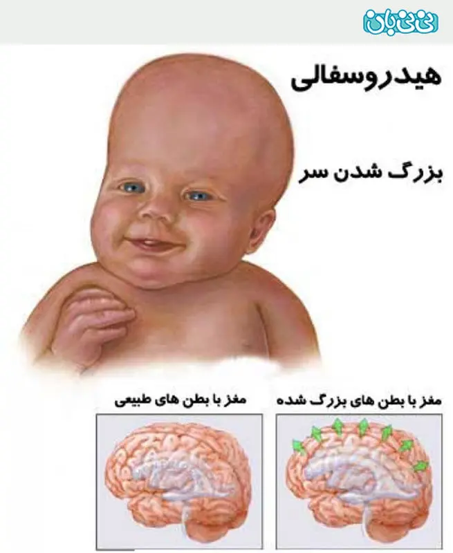 علت هیدروسفالی جنین، پیشگیری سریع موثره؟