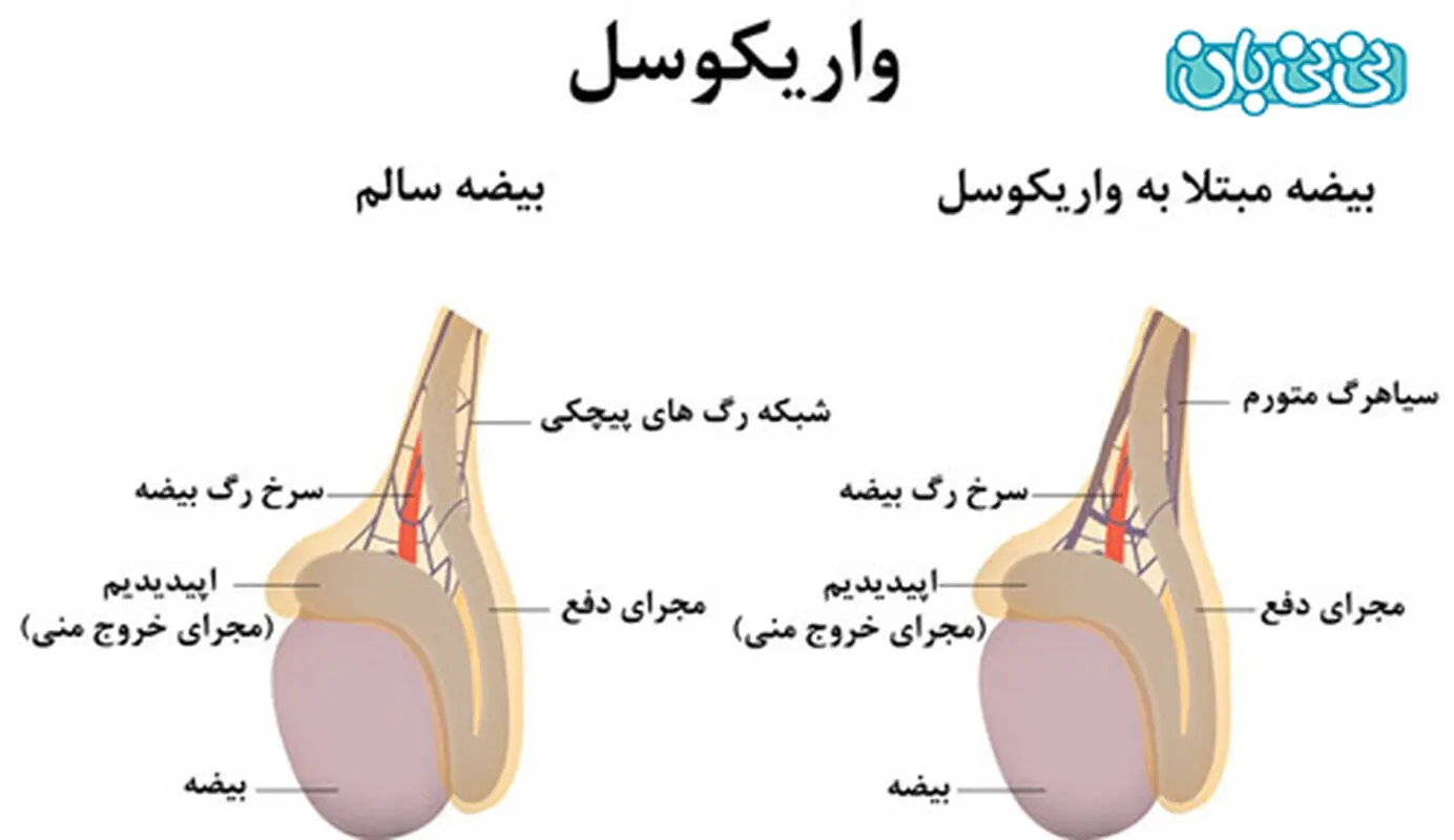 درمان واریکوسل در مردان، توصیه طب سنتی