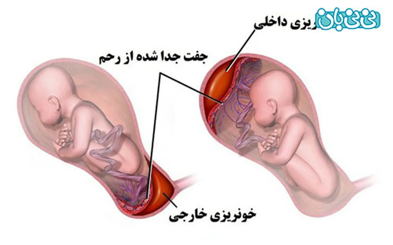 ترشحات قهوه ای در بارداری، زنگ هشدار؟