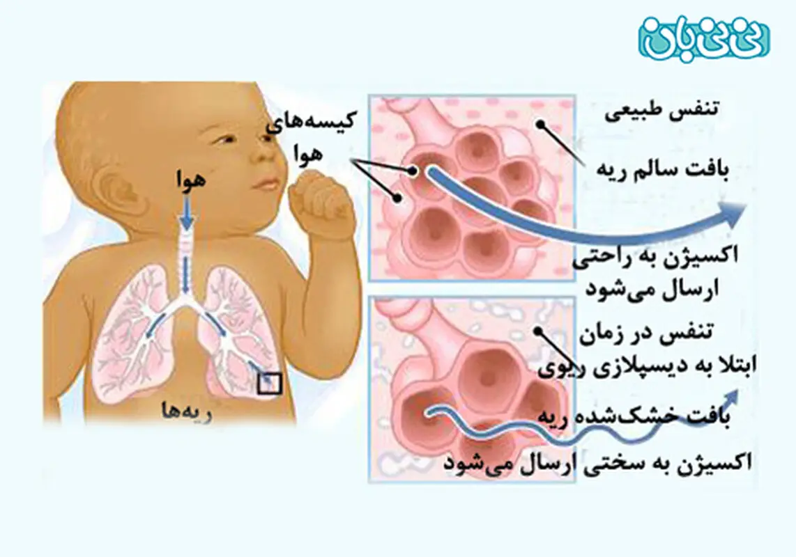 مشکل تنفسی نوزاد در بدو تولد، علت
