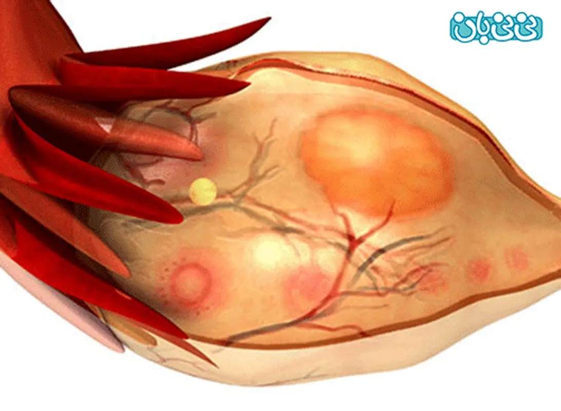 تخمدان پلی کیستیک یعنی چی؟