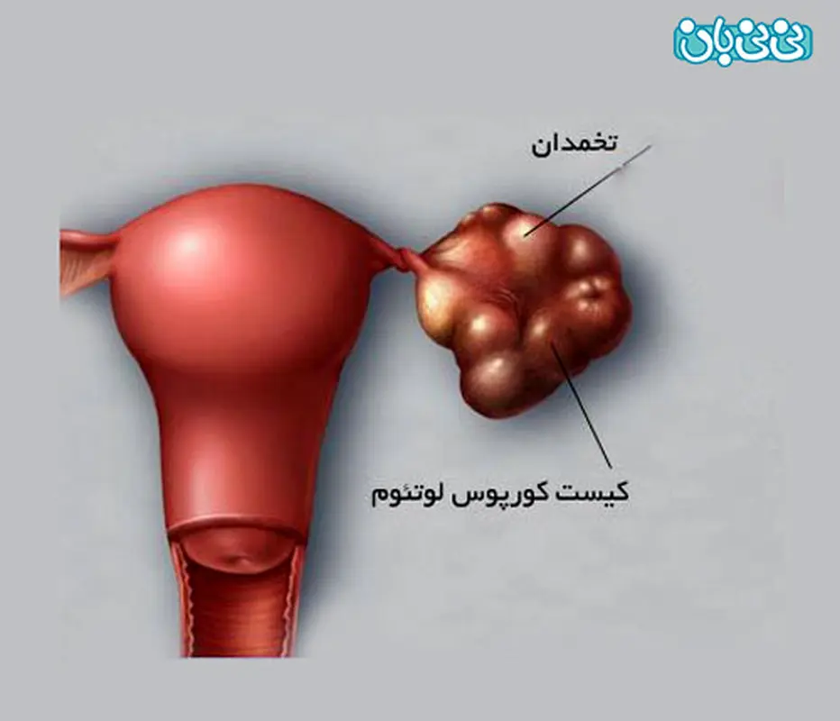 درمان کیست لوتئال تخمدان