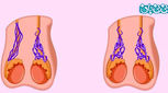 چرا واریکوسل میگیریم؟