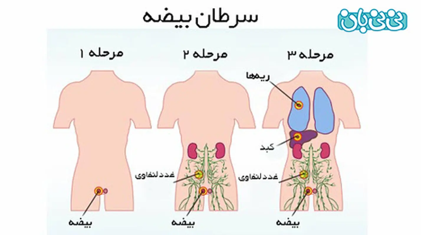 آیا کیست بیضه خطرناک است؟