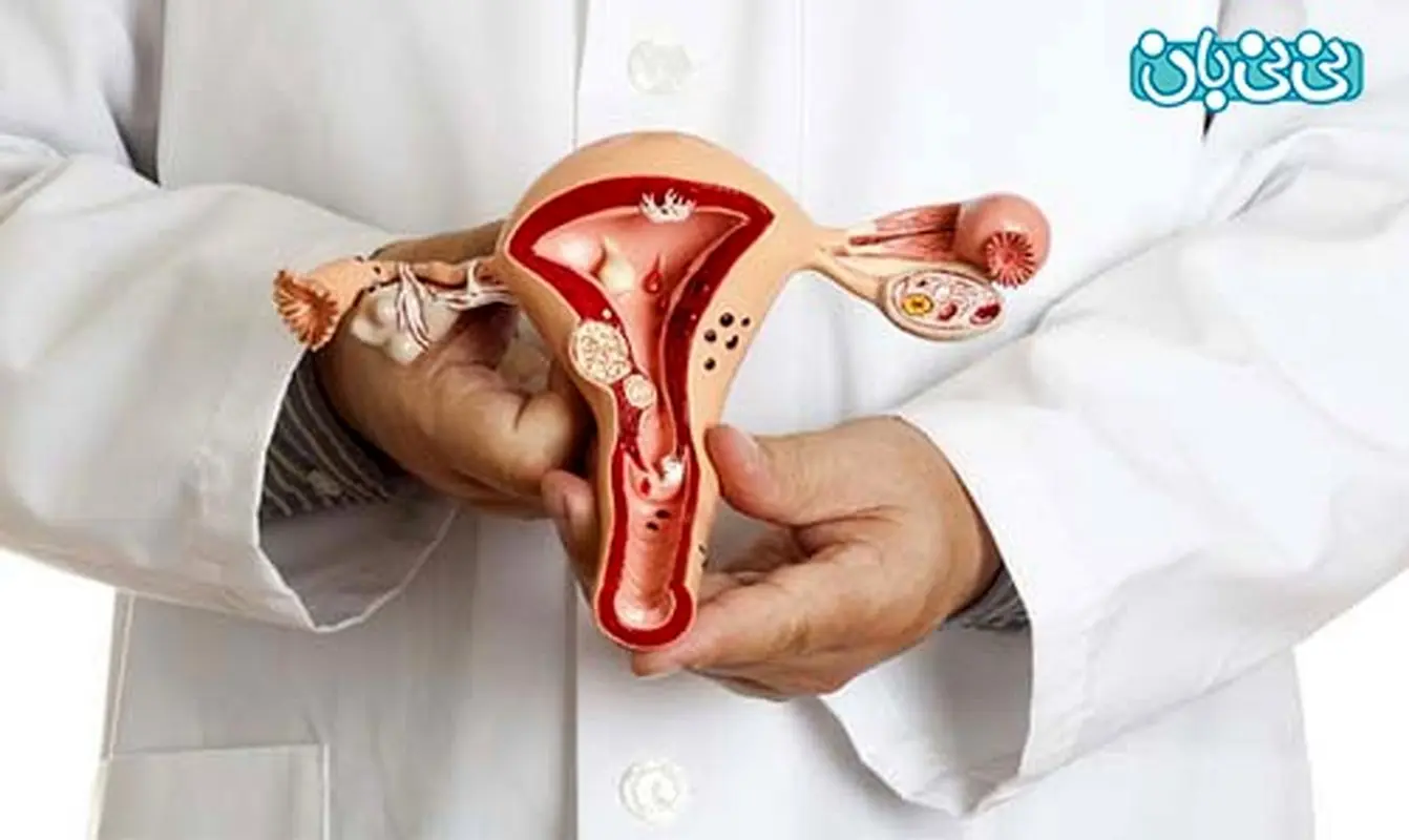 انواع توده های تخمدانی، خطرناک ترین ها