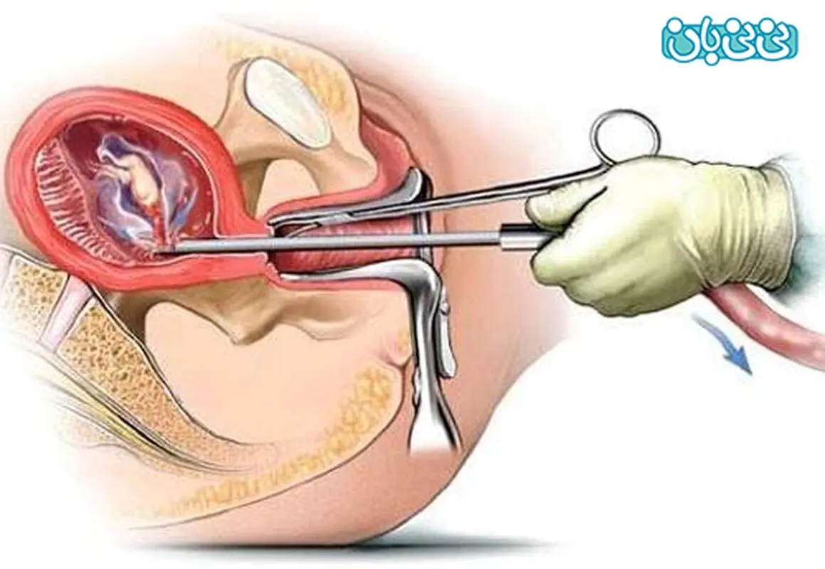 بعد از عمل کورتاژ چه باید کرد؟