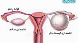 درمان تنبلی تخمدان با رازیانه، موثر است؟