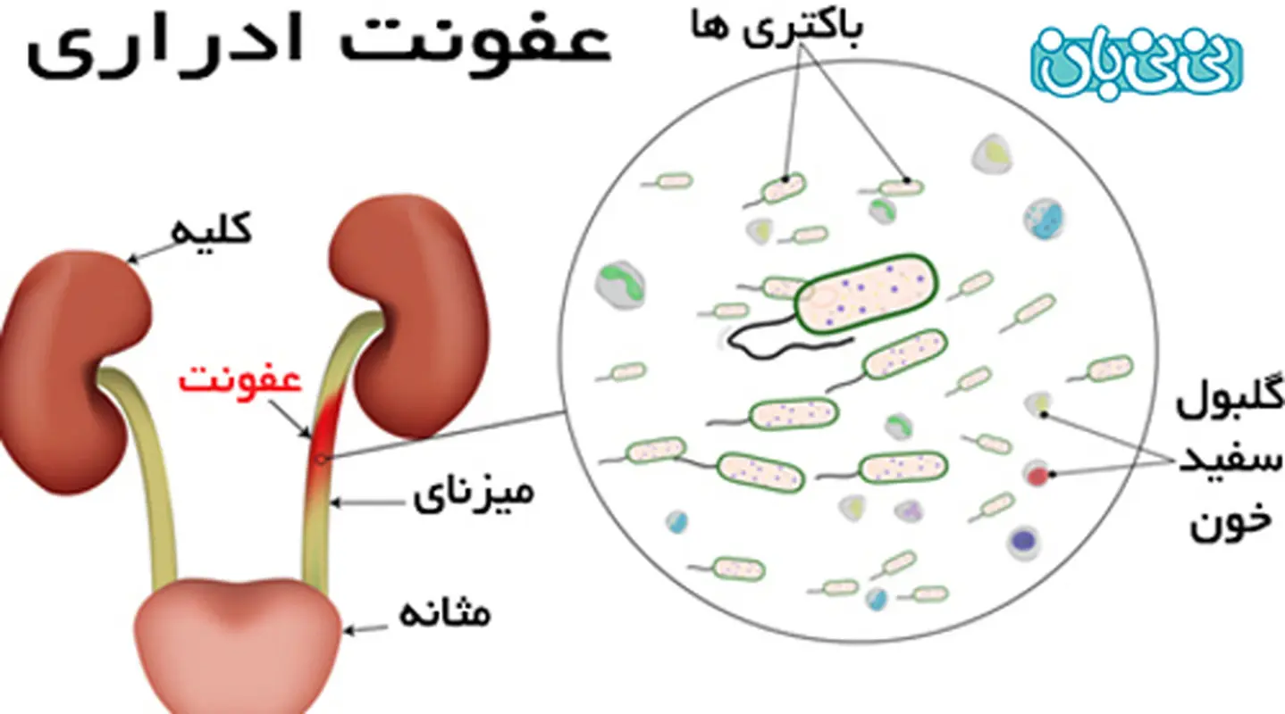 علت درد مثانه در زنان، تشخیص و درمان