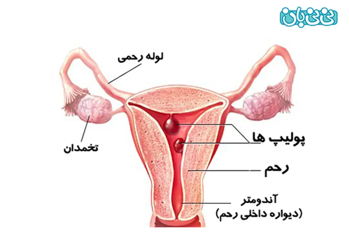 علائم پولیپ رحم، راه‌های تشخیص