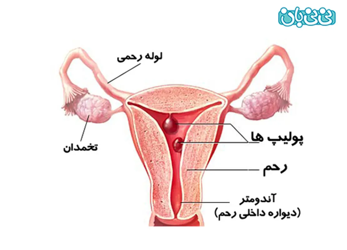 علائم پولیپ رحم، راه‌های تشخیص