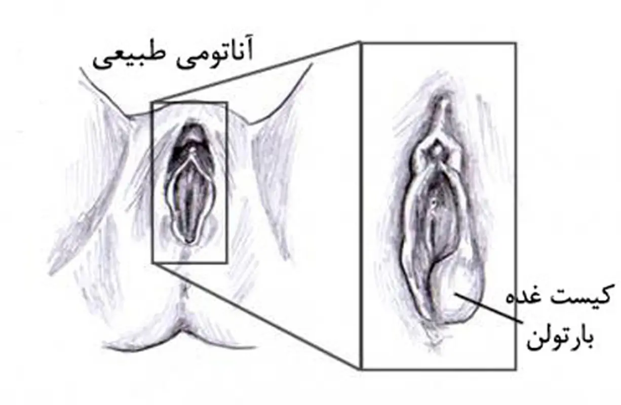 غدد بارتولن در بارداری، چگونه درمان می‌شود؟