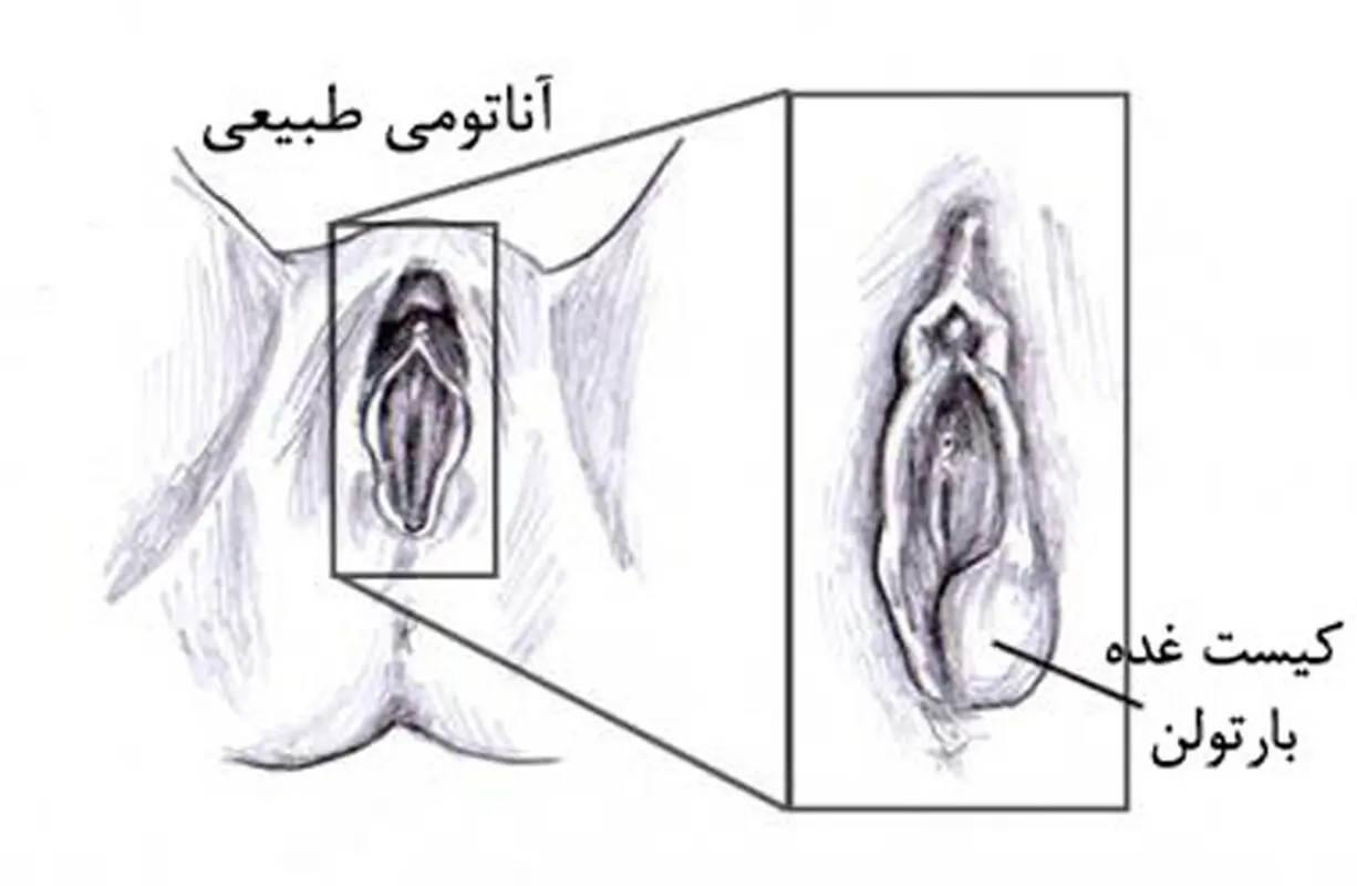غدد بارتولن در بارداری، چگونه درمان می‌شود؟