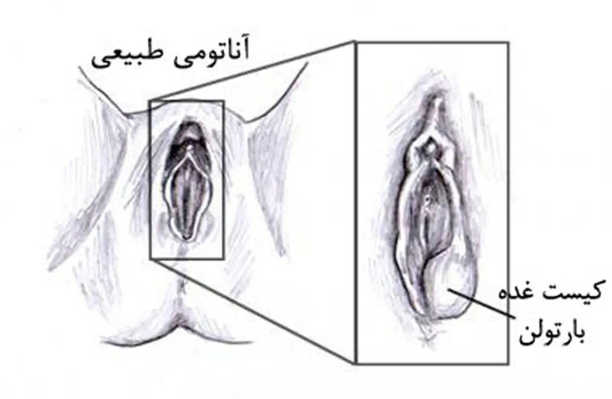 غدد بارتولن در بارداری، چگونه درمان می‌شود؟