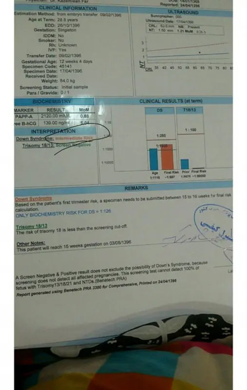 ریسک سندروم داون در غربالگری، ممکنه اشتباه شده باشد؟