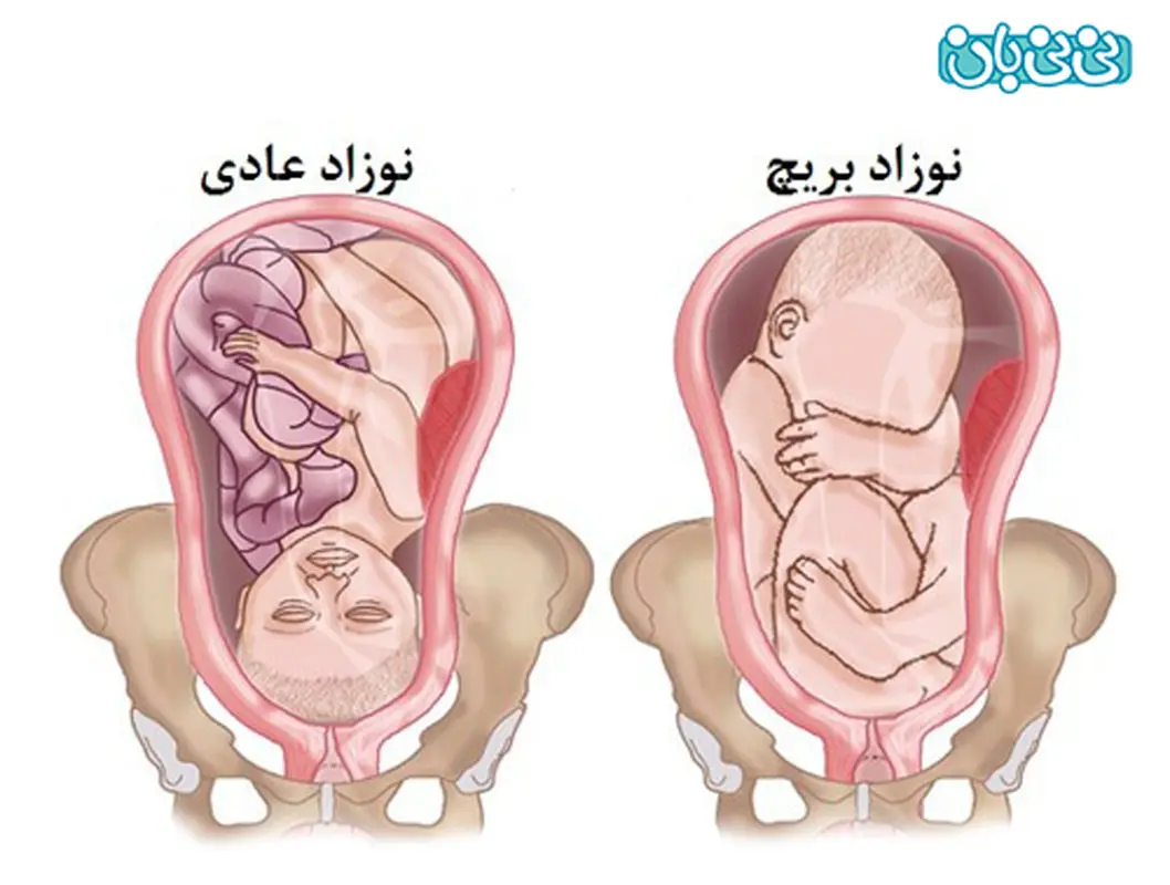 علت بریچ بودن جنین چیست؟