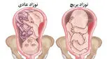 علت بریچ بودن جنین چیست؟