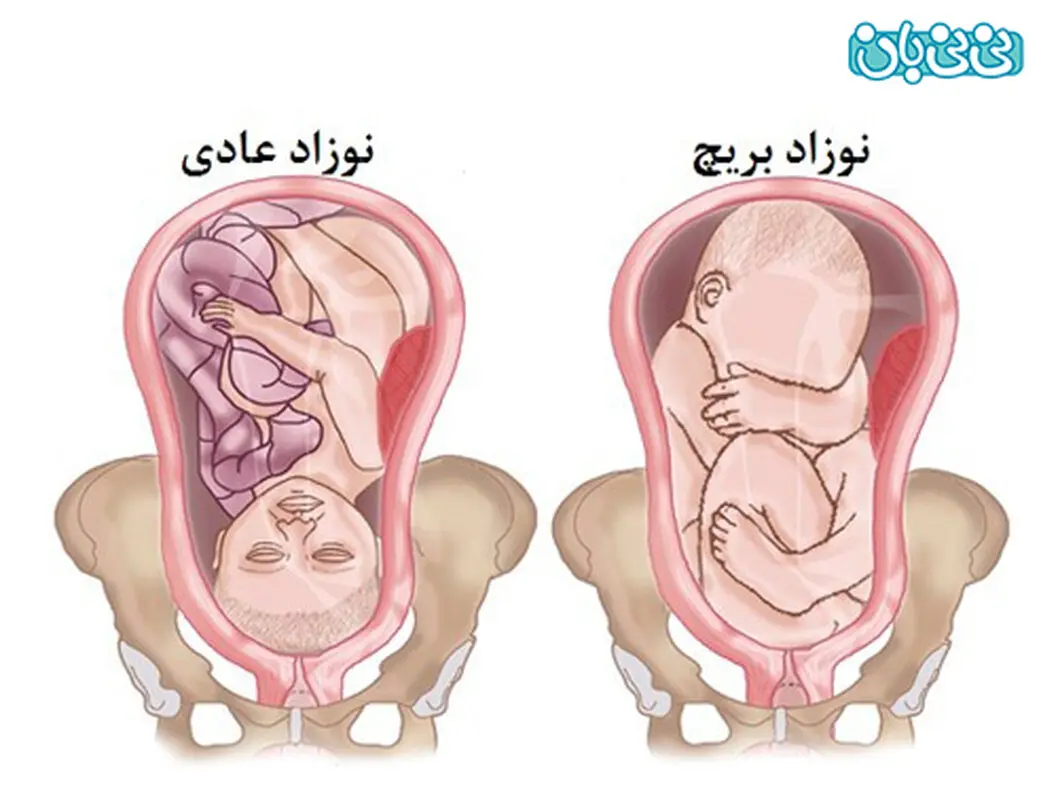 علت بریچ بودن جنین چیست؟